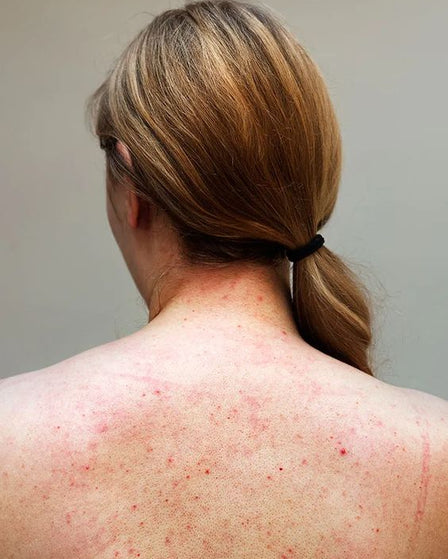 The Science Behind Clearer Skin: Can Hard Water Cause Acne?