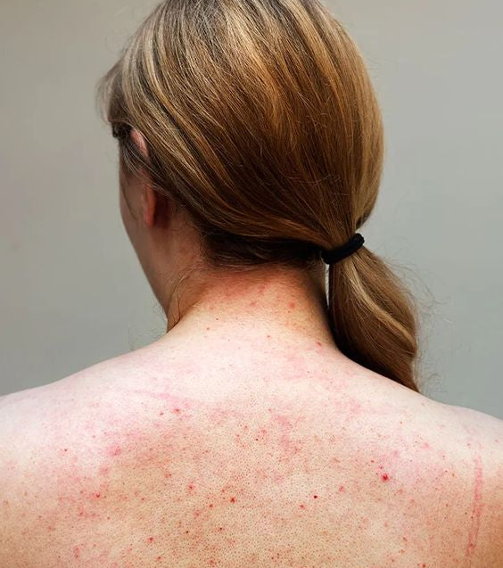 woman's back with acne to answer the question; can hard water cause acne